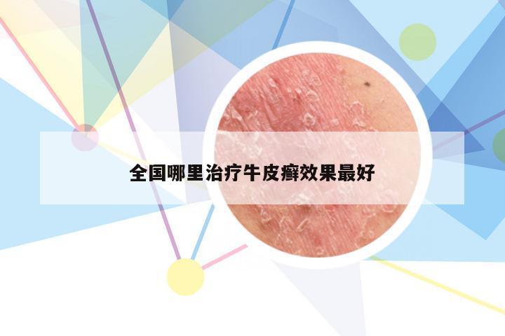 全国哪里治疗牛皮癣效果最好