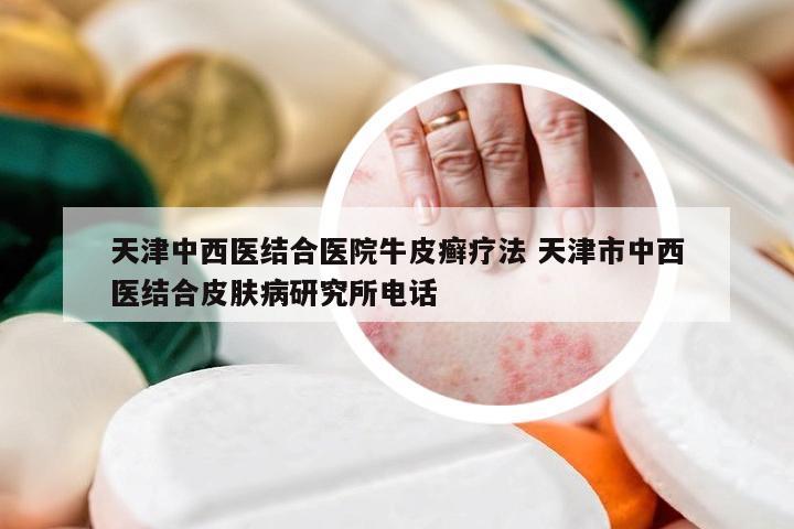 天津中西医结合医院牛皮癣疗法 天津市中西医结合皮肤病研究所电话