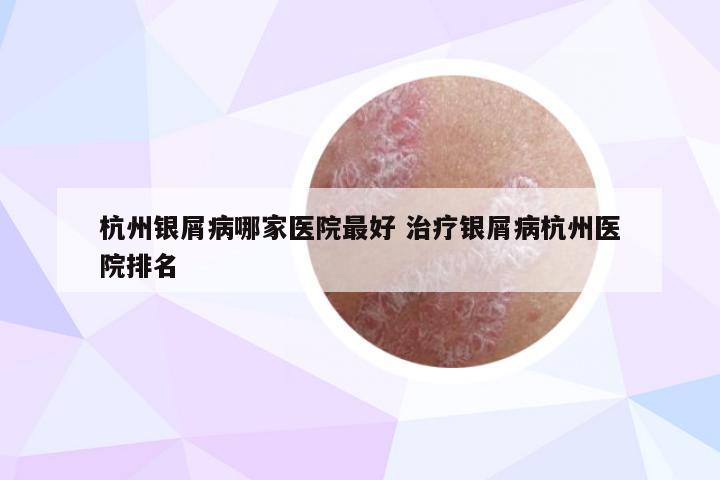 杭州银屑病哪家医院最好 治疗银屑病杭州医院排名