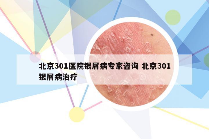 北京301医院银屑病专家咨询 北京301银屑病治疗