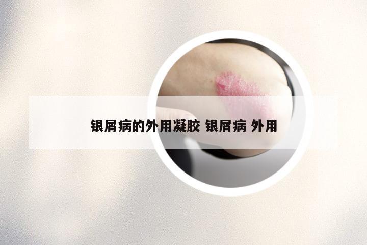 银屑病的外用凝胶 银屑病 外用