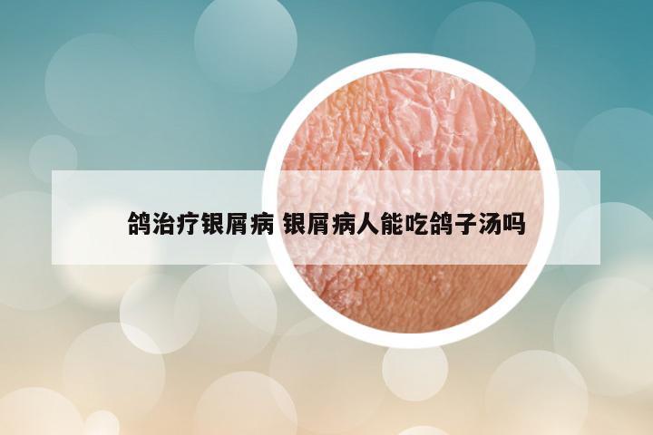 鸽治疗银屑病 银屑病人能吃鸽子汤吗