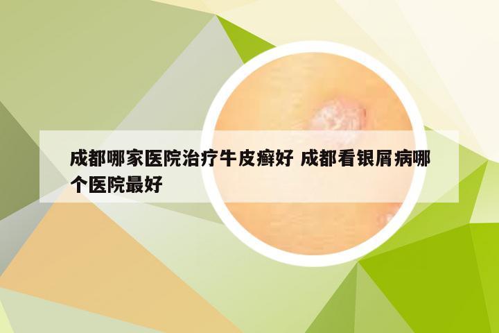 成都哪家医院治疗牛皮癣好 成都看银屑病哪个医院最好