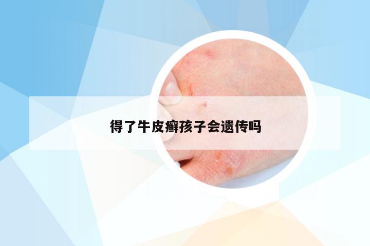 得了牛皮癣孩子会遗传吗