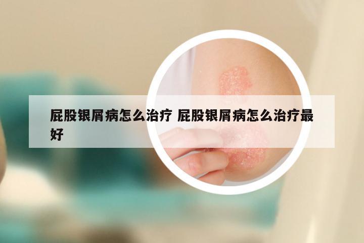 屁股银屑病怎么治疗 屁股银屑病怎么治疗最好