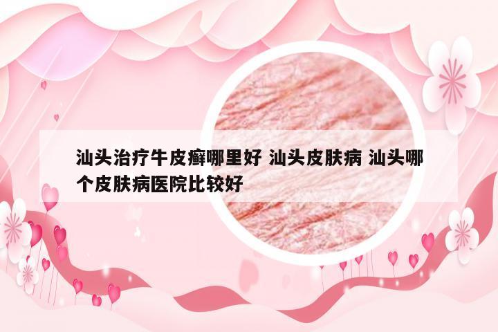 汕头治疗牛皮癣哪里好 汕头皮肤病 汕头哪个皮肤病医院比较好