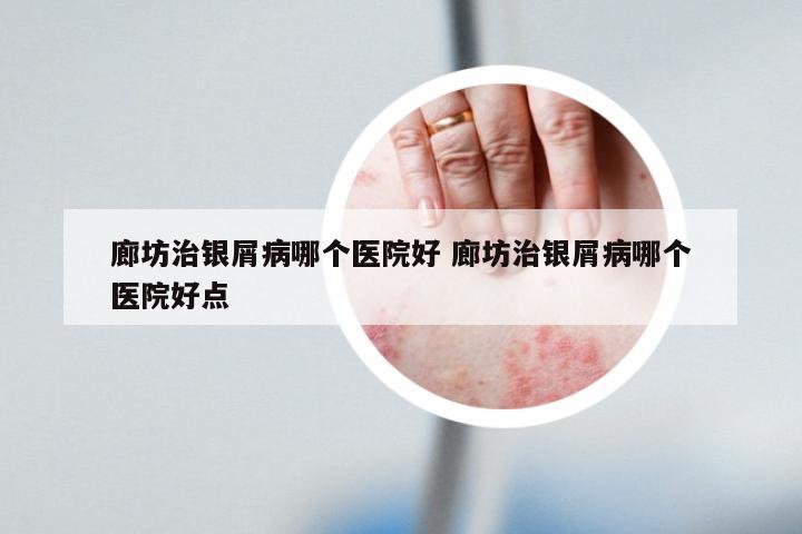 廊坊治银屑病哪个医院好 廊坊治银屑病哪个医院好点