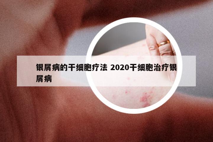 银屑病的干细胞疗法 2020干细胞治疗银屑病