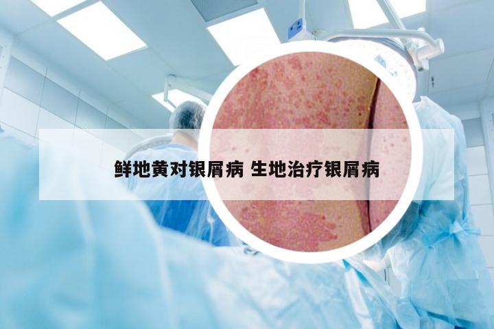 鲜地黄对银屑病 生地治疗银屑病