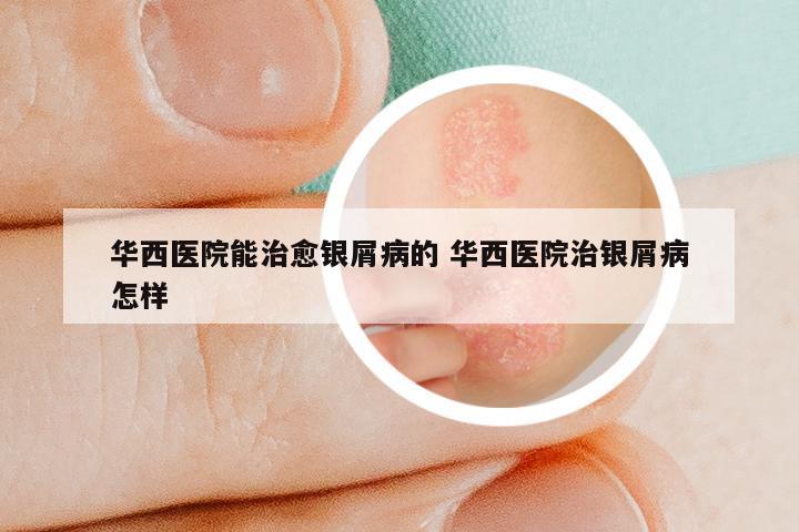 华西医院能治愈银屑病的 华西医院治银屑病怎样