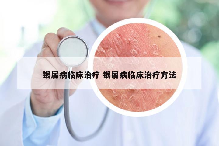 银屑病临床治疗 银屑病临床治疗方法