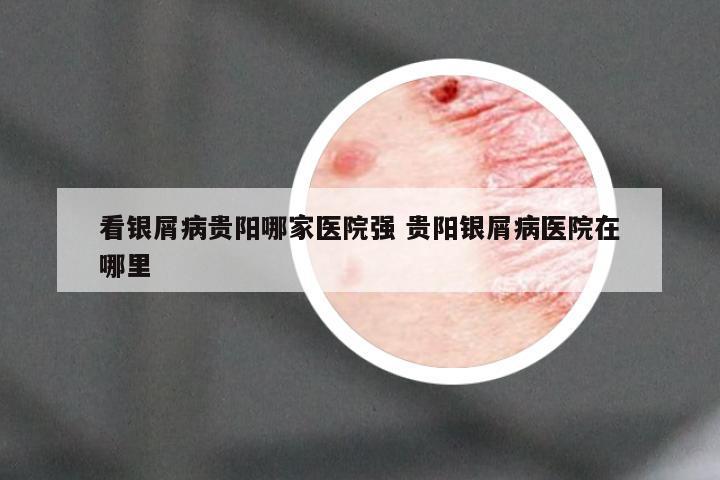 看银屑病贵阳哪家医院强 贵阳银屑病医院在哪里