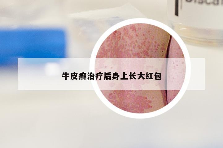 牛皮癣治疗后身上长大红包