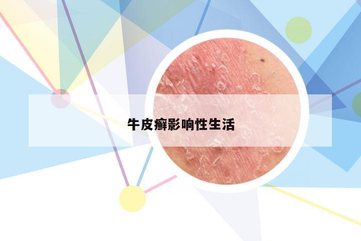 牛皮癣影响性生活