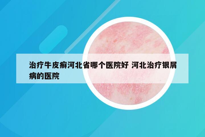 治疗牛皮癣河北省哪个医院好 河北治疗银屑病的医院