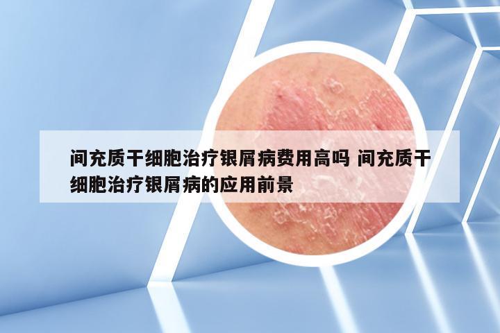 间充质干细胞治疗银屑病费用高吗 间充质干细胞治疗银屑病的应用前景