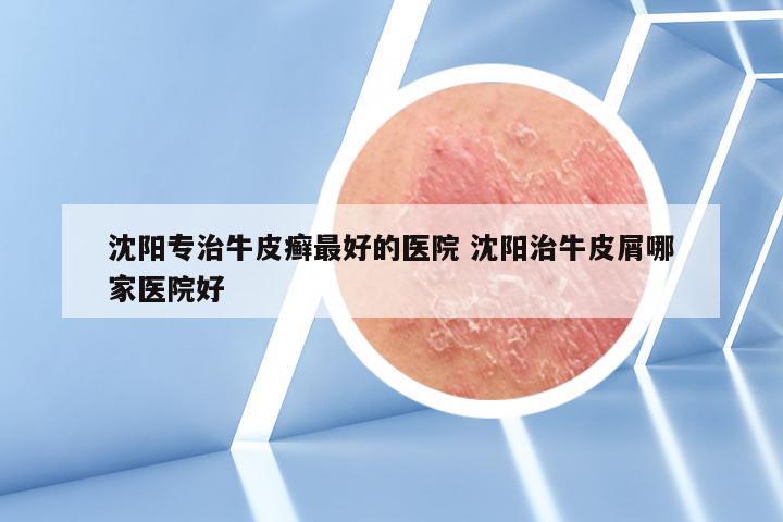 沈阳专治牛皮癣最好的医院 沈阳治牛皮屑哪家医院好