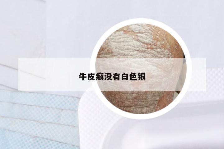 牛皮癣没有白色银