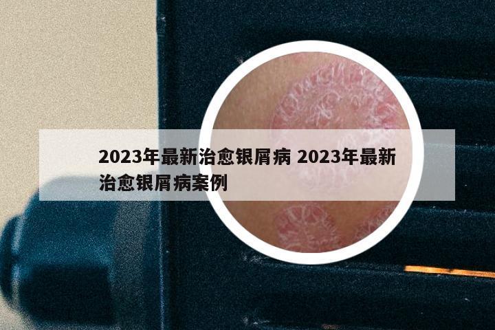 2023年最新治愈银屑病 2023年最新治愈银屑病案例