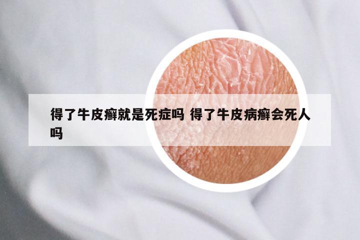 得了牛皮癣就是死症吗 得了牛皮病癣会死人吗