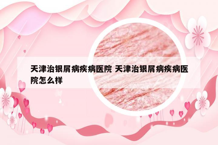 天津治银屑病疾病医院 天津治银屑病疾病医院怎么样