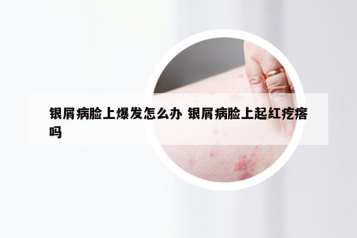 银屑病脸上爆发怎么办 银屑病脸上起红疙瘩吗