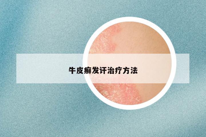 牛皮癣发讦治疗方法