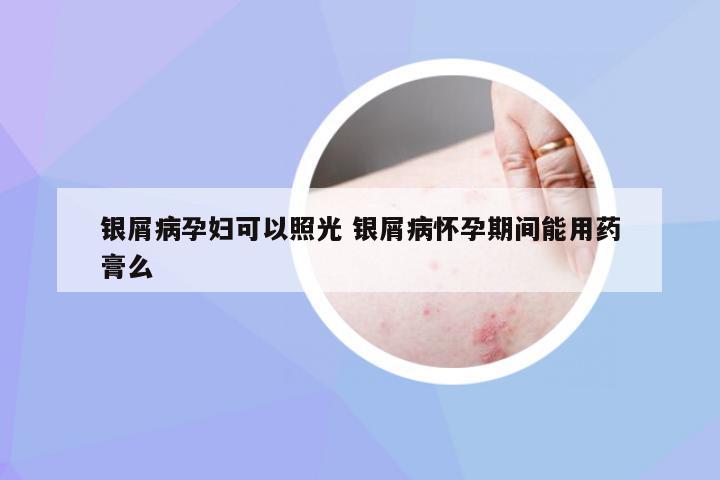 银屑病孕妇可以照光 银屑病怀孕期间能用药膏么