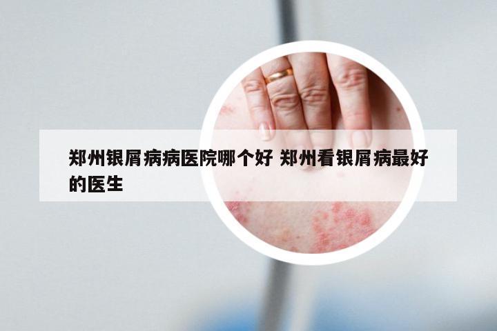 郑州银屑病病医院哪个好 郑州看银屑病最好的医生
