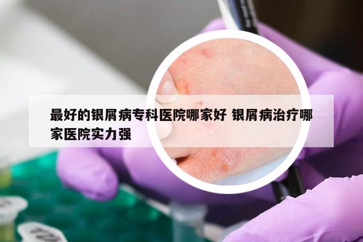 最好的银屑病专科医院哪家好 银屑病治疗哪家医院实力强