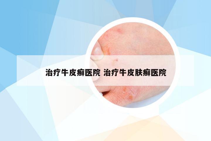 治疗牛皮癣医院 治疗牛皮肤癣医院