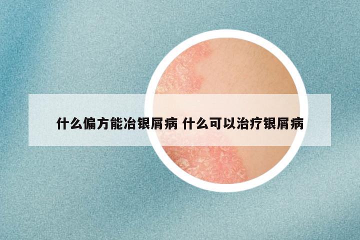 什么偏方能冶银屑病 什么可以治疗银屑病