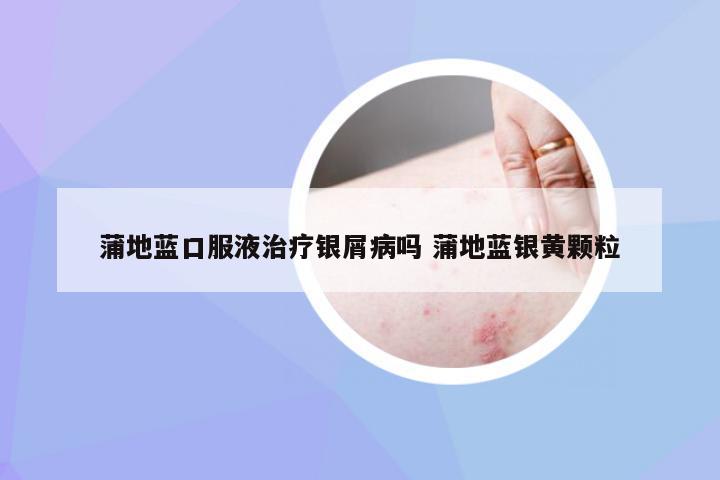蒲地蓝口服液治疗银屑病吗 蒲地蓝银黄颗粒