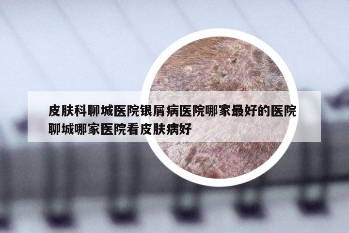 皮肤科聊城医院银屑病医院哪家最好的医院 聊城哪家医院看皮肤病好