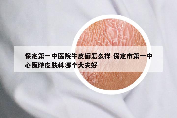 保定第一中医院牛皮癣怎么样 保定市第一中心医院皮肤科哪个大夫好