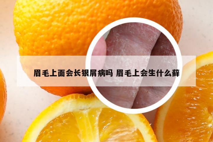 眉毛上面会长银屑病吗 眉毛上会生什么藓