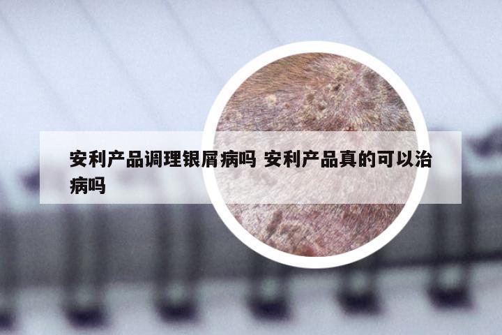 安利产品调理银屑病吗 安利产品真的可以治病吗