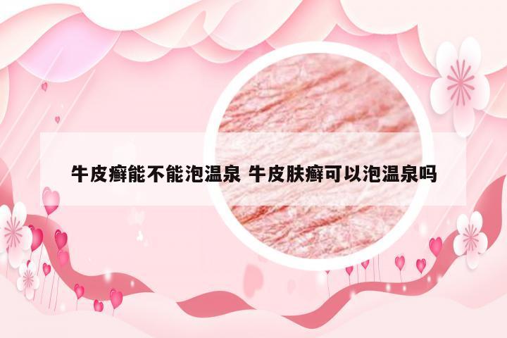 牛皮癣能不能泡温泉 牛皮肤癣可以泡温泉吗