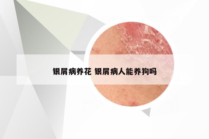 银屑病养花 银屑病人能养狗吗