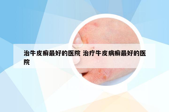 治牛皮癣最好的医院 治疗牛皮病癣最好的医院