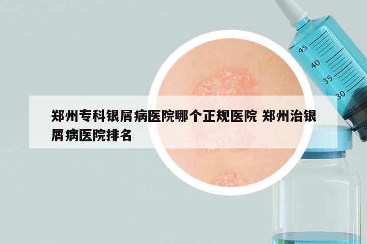 郑州专科银屑病医院哪个正规医院 郑州治银屑病医院排名