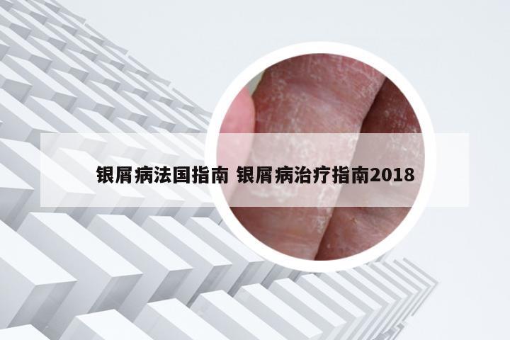 银屑病法国指南 银屑病治疗指南2018