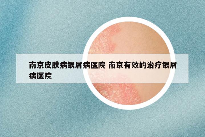 南京皮肤病银屑病医院 南京有效的治疗银屑病医院