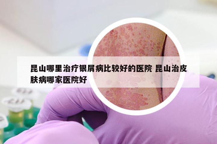 昆山哪里治疗银屑病比较好的医院 昆山治皮肤病哪家医院好