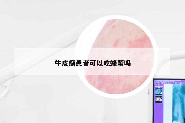 牛皮癣患者可以吃蜂蜜吗