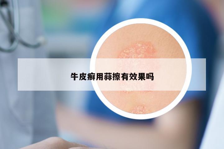 牛皮癣用蒜擦有效果吗