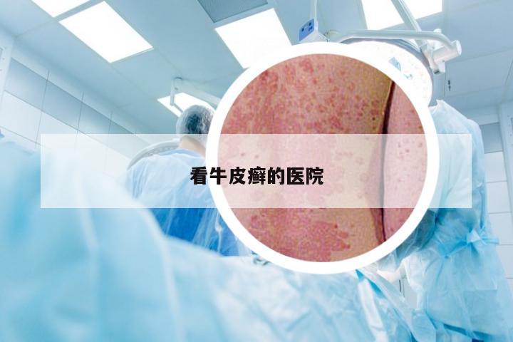 看牛皮癣的医院