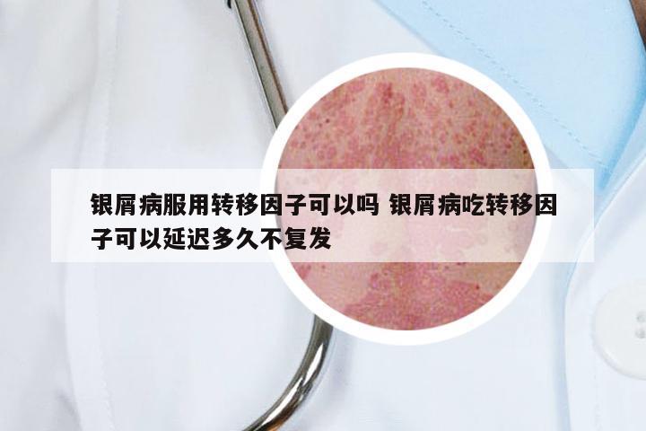 银屑病服用转移因子可以吗 银屑病吃转移因子可以延迟多久不复发