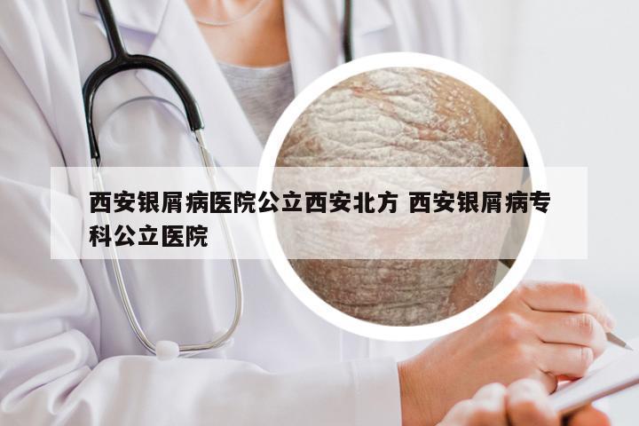 西安银屑病医院公立西安北方 西安银屑病专科公立医院