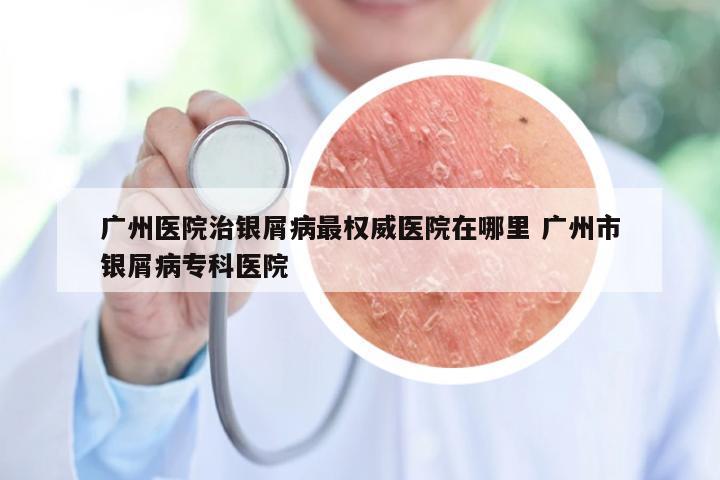 广州医院治银屑病最权威医院在哪里 广州市银屑病专科医院